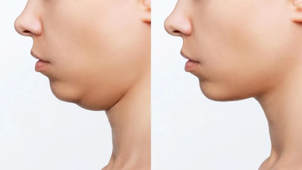 Double Chin Removal